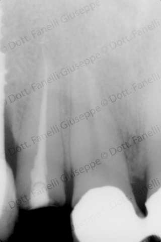 Endodonzia 4 Endodonzia 4