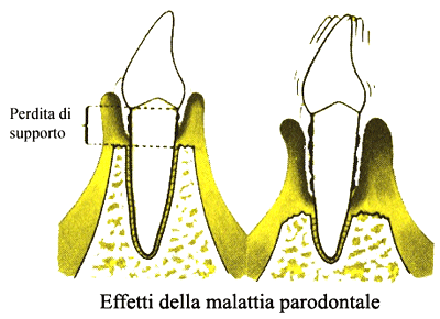 malattie parodontali