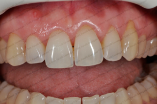 sbiancamento-denti-1 sbiancamento-denti-1
