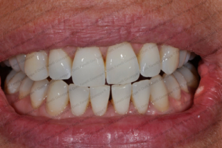 sbiancamento-denti-2 sbiancamento-denti-2